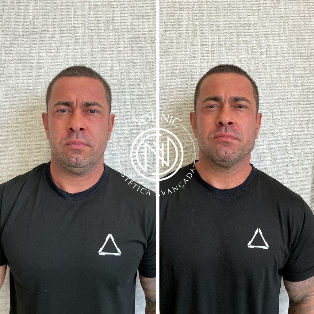 Rafael Quintanilha da Rocha - Preenchimento Facial - 2025_12_17